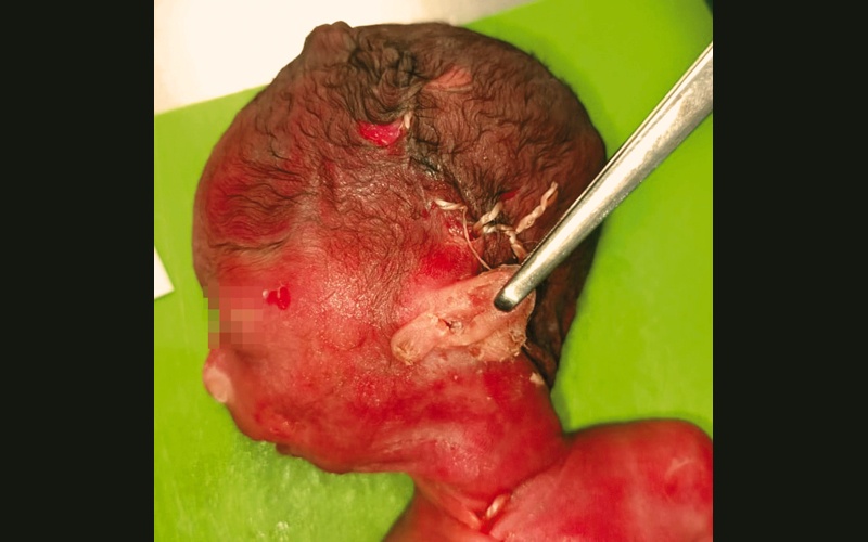 Патологоанатомическое исследование плода - преаурикулярный вырост левой ушной раковины