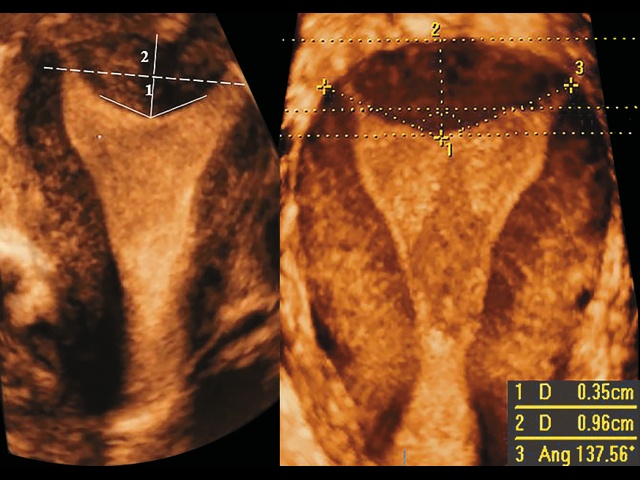 Схема исследования и измерения критериев ультразвуковой оценки формы матки на корональном срезе