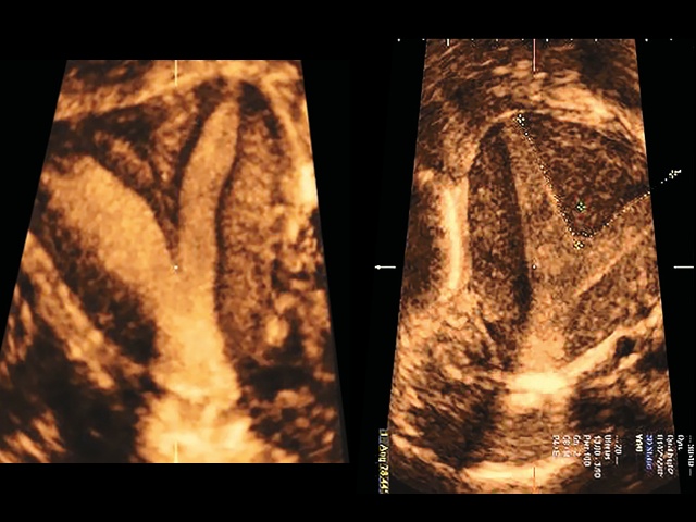 Эхограммы перегородчатой формы полости матки (б)
