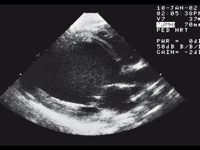 Токсическое поражение миокарда на фоне химиотерапии с формированием гигантского левого желудочка по типу дилатационной кардиомиопатии