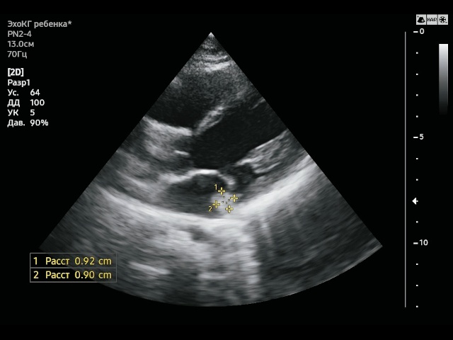 Образование левой АВ-борозды округлой формы размерами 9,2х9,0 мм. Парастернальная проекция по длинной оси левого желудочка. В-режим