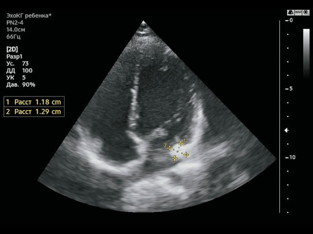 Образование левой АВ-борозды округлой формы размерами 11,8х12,9 мм. Апикальная четырехкамерная проекция. В-режим