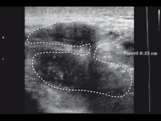 Эхограммы перегородчатой формы полости матки (а)