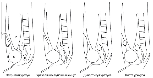 Схема аномалий урахуса