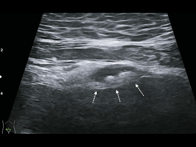 B-режим, поперечное сканирование линейным датчиком, по передней стенке в области верхушки мочевого пузыря определяется кистозное образование (стрелки) с тонкими стенками, наличием перегородок и гиперэхогенными включениями (а)
