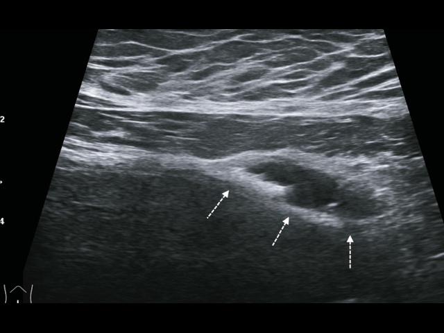 B-режим, продольное сканирование линейным датчиком, по передней стенке в области верхушки мочевого пузыря определяется кистозное образование (стрелки) с тонкими стенками, наличием перегородок и гиперэхогенными включениями (б)