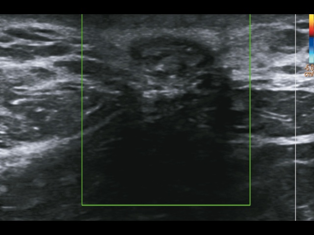 Пациент Б. Эхограмма урахеально-пупочного синуса у пациента с околопузырной кистой урахуса, поперечное сканирование линейным датчиком (б)