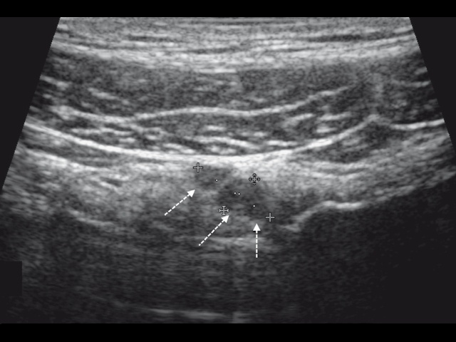 Пациент Б. Эхограмма околопузырной кисты урахуса и пупочной грыжи, В-режим, исследование линейным датчиком. Продольное сканирование (а)