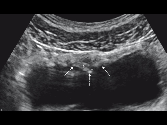 Пациент Б. Эхограмма околопузырной кисты урахуса и пупочной грыжи, В-режим, исследование линейным датчиком. Поперечное сканирование. По передней стенке в области верхушки мочевого пузыря по средней линии - кистозное образование с тонкой перегородкой размерами 0,9х0,8х0,9 см (стрелки) (в)