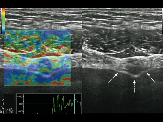 Режим компрессионной эластографии, поперечное сканирование. При соноэластографии образование (стрелки) картируется трехцветно (г)