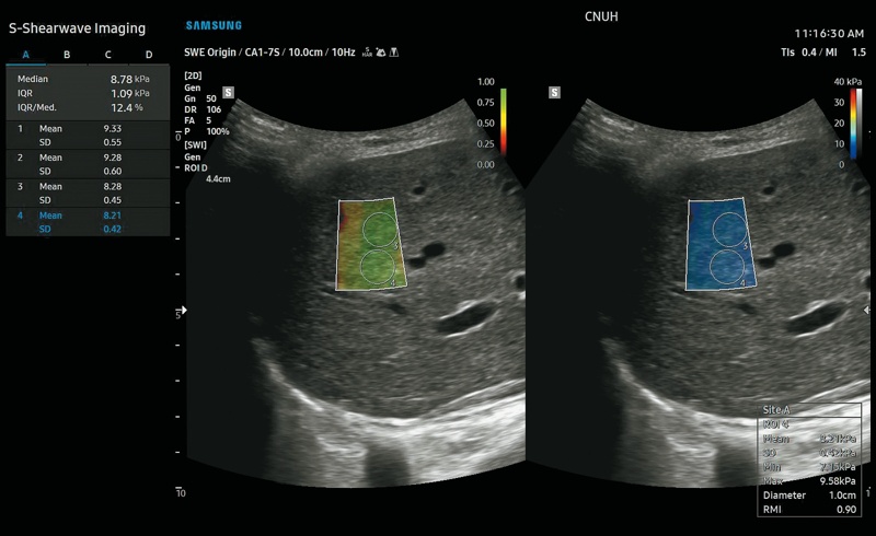 Пример выходного изображения, полученного с помощью технологии S-Shearwave Imaging. RMI (слева) и значение жесткости (справа) отображаются в верхней части изображений B-режима