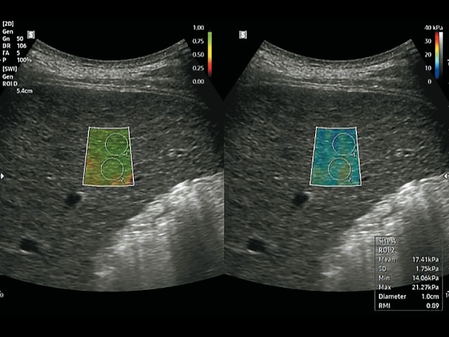 Примеры изображений, полученных с помощью технологии 2D-SWE, и медианные значения жесткости, рассчитанные с помощью V8 S-Shearwave Imaging (г)