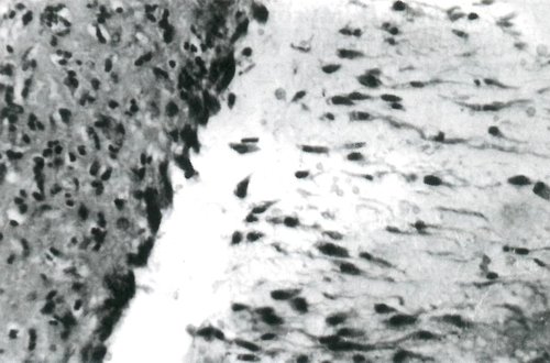 Участок стенки кисты аппендикса у его основания с наличием выстилки из кубического и цилиндрического слизеобразующего эпителия со слизеобразующими клетками в просвете кисты среди слизи (увеличение х 280)