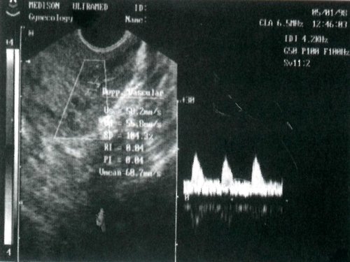 ТРУЗИ - кровоток в маточной артерии девочки через 1 год после менархе