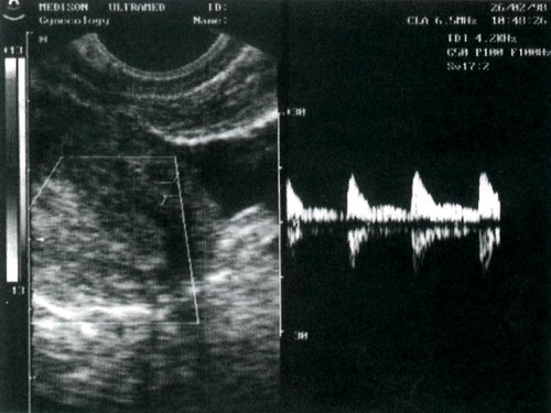 ТРУЗИ - кровоток в маточной артерии девочки через 2 года после менархе