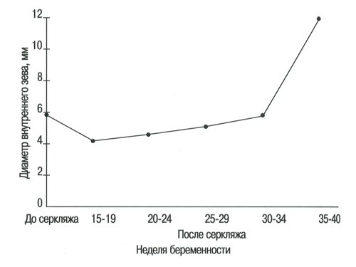 Номограмма - диаметр внутреннего зева до и после серкляжа