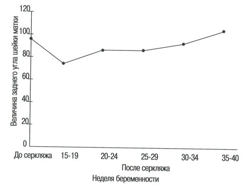 Номограмма - величина заднего угла шейки матки в группе беременных с высоким риском до и после проведения серкляжа