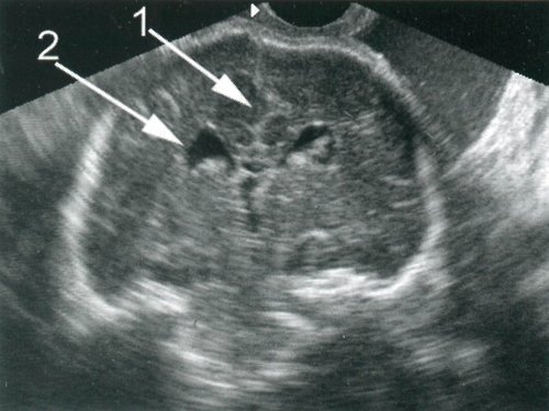 Порок Арнольда-Киари II типа - фронтальное сканирование, деформация межполушарной щели (1), наличие дополнительной латеральной стенки бокового желудочка (2)