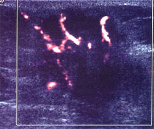 Кровоток в инфильтрирующей карциноме (б)