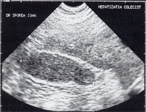 УЗИ: Гепатизация желчного пузыря, полностью заполненного сладжем