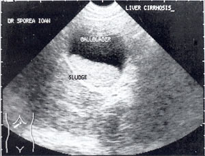 УЗИ: Желчный сладж у больного с циррозом печени
