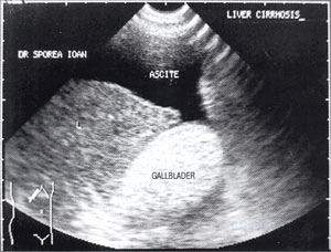 УЗИ: Желчный пузырь, заполненный сладжем, у больного циррозом