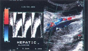 Эхограмма: расширенная до 6 мм печеночная артерия с параллельным ходом по отношению к воротной вене