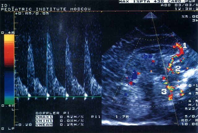УЗ-эхограмма головного мозга новорожденного (сагиттальный срез через большой родничок) и допплерограмма кровотока по базиллярной артерии