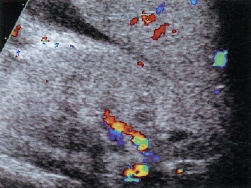 Дуплексное допплеровское сканирование почки здорового ребенка трех лет