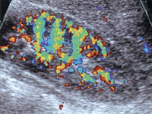 Дуплексное допплеровское сканирование почки ребенка с гемолитико-уремическим синдромом