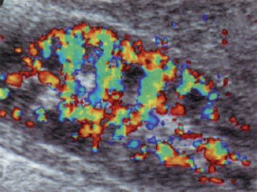 Дуплексное допплеровское сканирование почки здорового ребенка в фазу систолы сердечного цикла