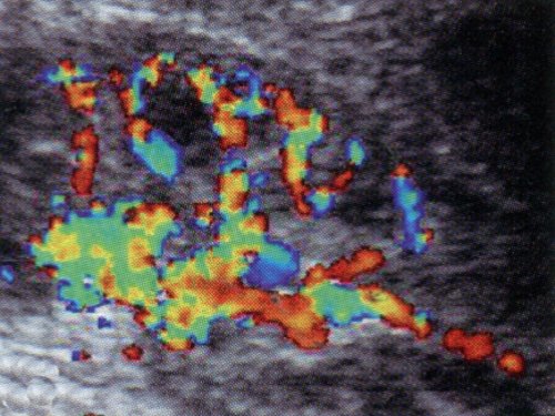 Дуплексное допплеровское сканирование почки здорового ребенка в фазу диастолы сердечного цикла