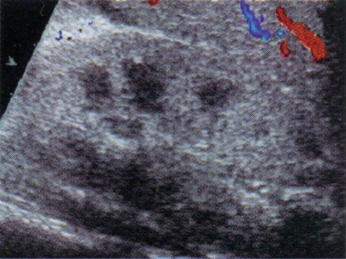 Дуплексное допплеровское сканирование почки больного гемолитико-уремическим синдромом в фазу диастолы
