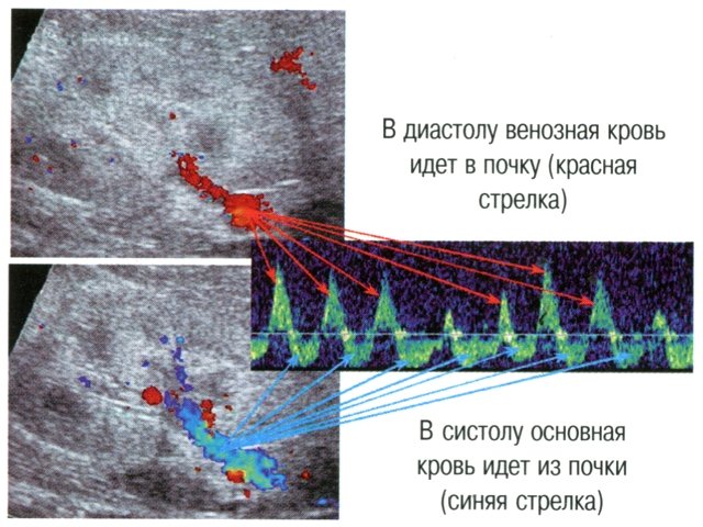 Необычный паттерн венозного опока из почки (уровень ствола почечной вены) у больного гемолитико-уремическим синдромом