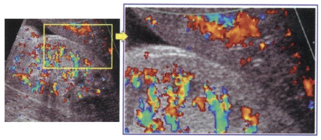 Эхографическая фаза 'глаукомы' почки: дуплексное допплеровское сканирование почки - восстановление кровотока в медуллярном слое при сохранении ишемии кортикального слоя паренхимы