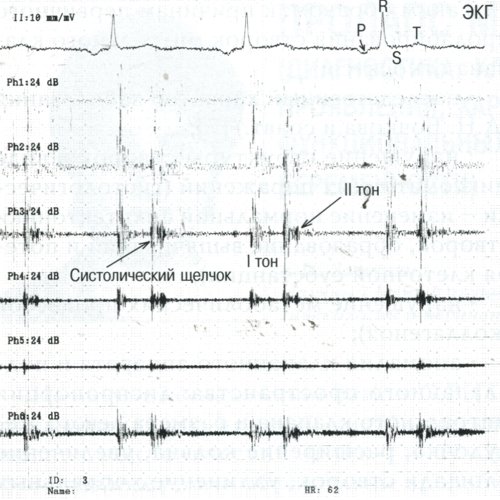 Электрокардиограмма (II стандартное отведение) и фонокардиограмма