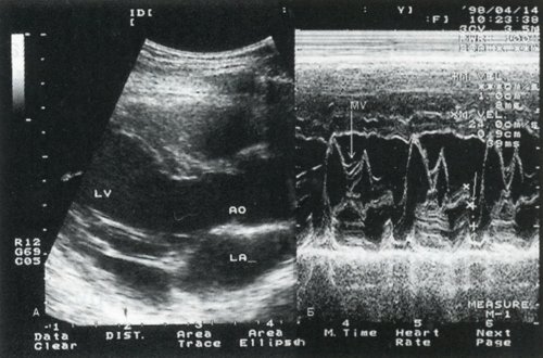 УЗИ сердца: Пролапс передней створки (стрелка вниз) и пролапс задней створки митрального клапана (стрелка вверх)