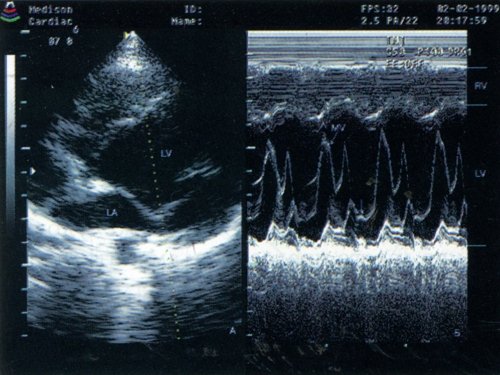 УЗИ сердца: Признаки объемной перегрузки левого желудочка, пролабирование обеих створок митрального клапана