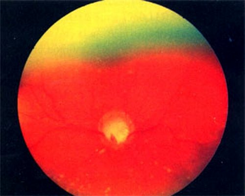 Глаукоматозная экскавация диска