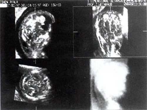 Патологически толстая шейная складка плода при сроке беременности 12 недель. Венечный и поперечный срезы шейной области показывают наличие шейных кист