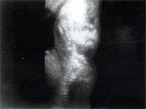 Ультразвуковое изображение эмбриона в 12 недель, показывающее патологическое увеличение толщины шейной складки