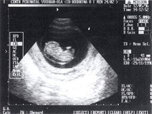 Эмбрион внутри амниотической полости (ТВ-сканирование)