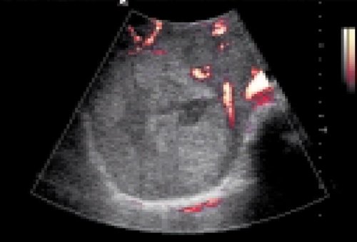 Множественные метастазы рака неустановленной локализации в печень, энергетический допплер