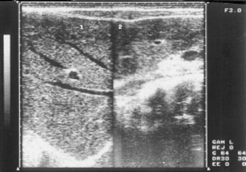 Эхограмма печени больного хроническим миелолейкозом (фаза бластного криза)