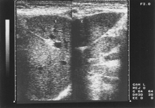 Эхограмма печени больной хроническим лимфолейкозом (стадия С)