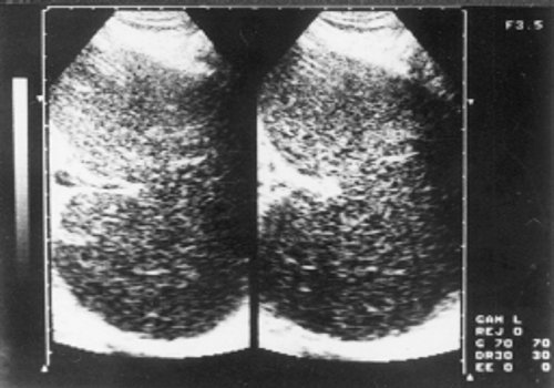 Эхограмма селезенки больного хроническим лимфолейкозом (стадия С)