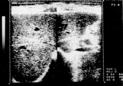 Эхограмма печени больного хроническим миелолейкозом (прогрессирующая фаза)