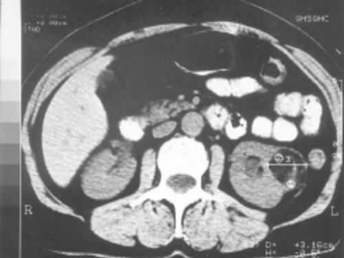КТ на уровне образования округлой формы в левой почке