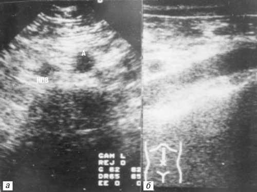 УЗ-эхограммы брюшной полости и забрюшинного пространства