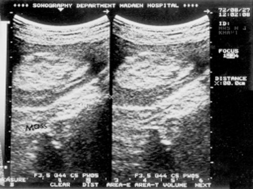 Ультрасонографическая картина инвагинации, вызванной липомой ободочной кишки (симптом псевдопочки с обширной центральной гиперэхогенной областью)